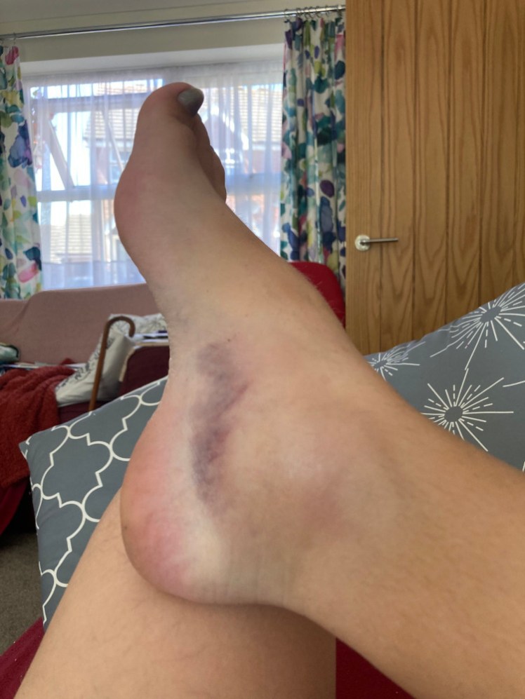 One very swollen and bruised ankle raised up and resting against my other propped-up knee.